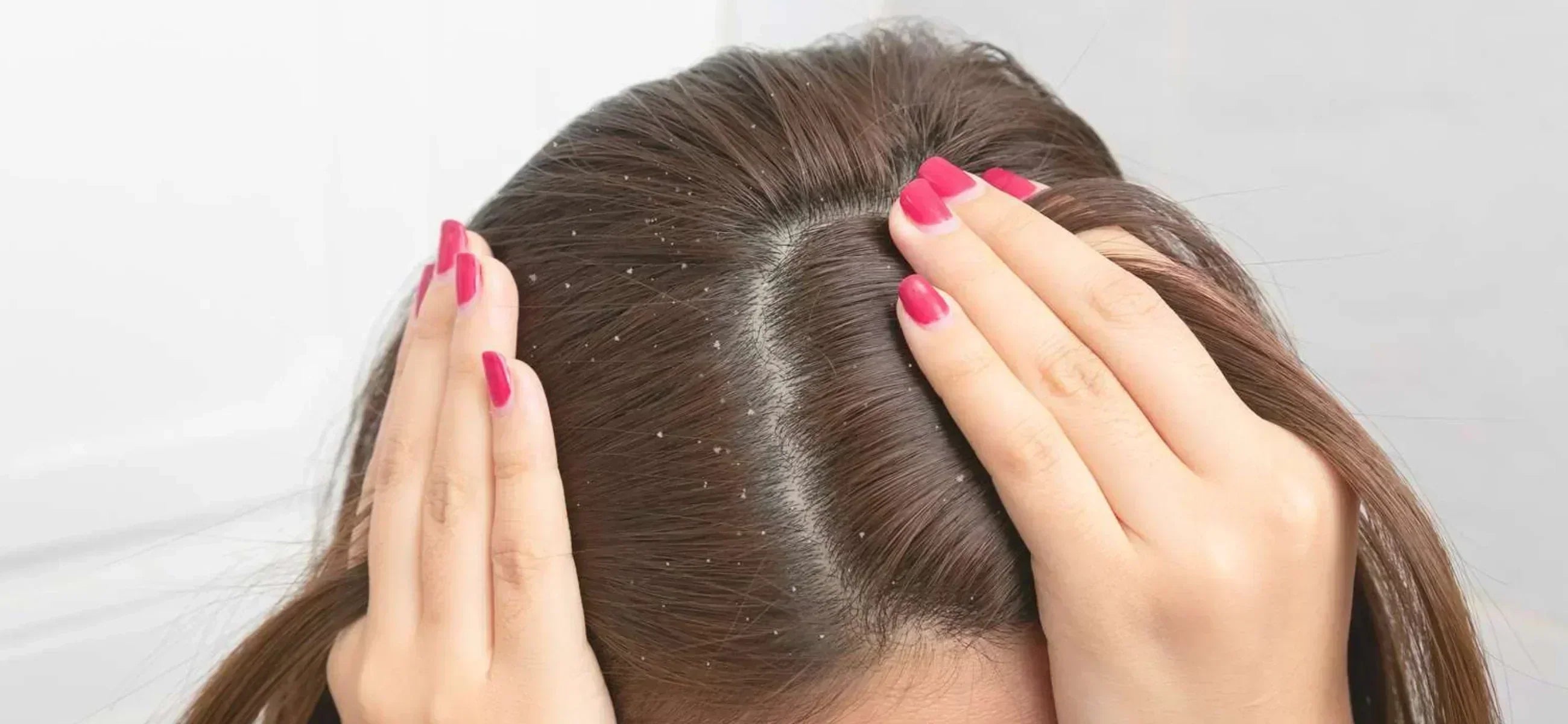 What causes dandruff? Triggers and treatments you should know