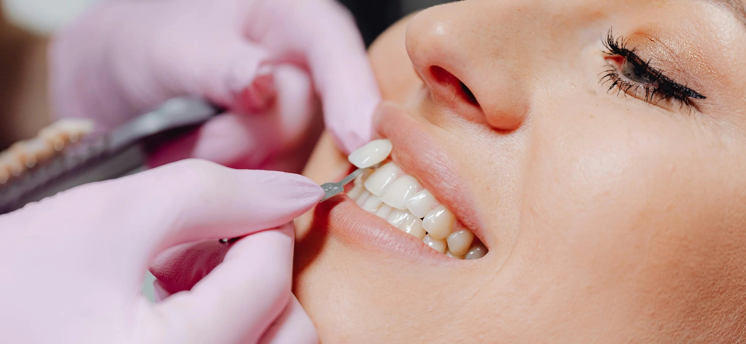 Cosmetic dentistry 101 - How to elevate your smile with dental veneers