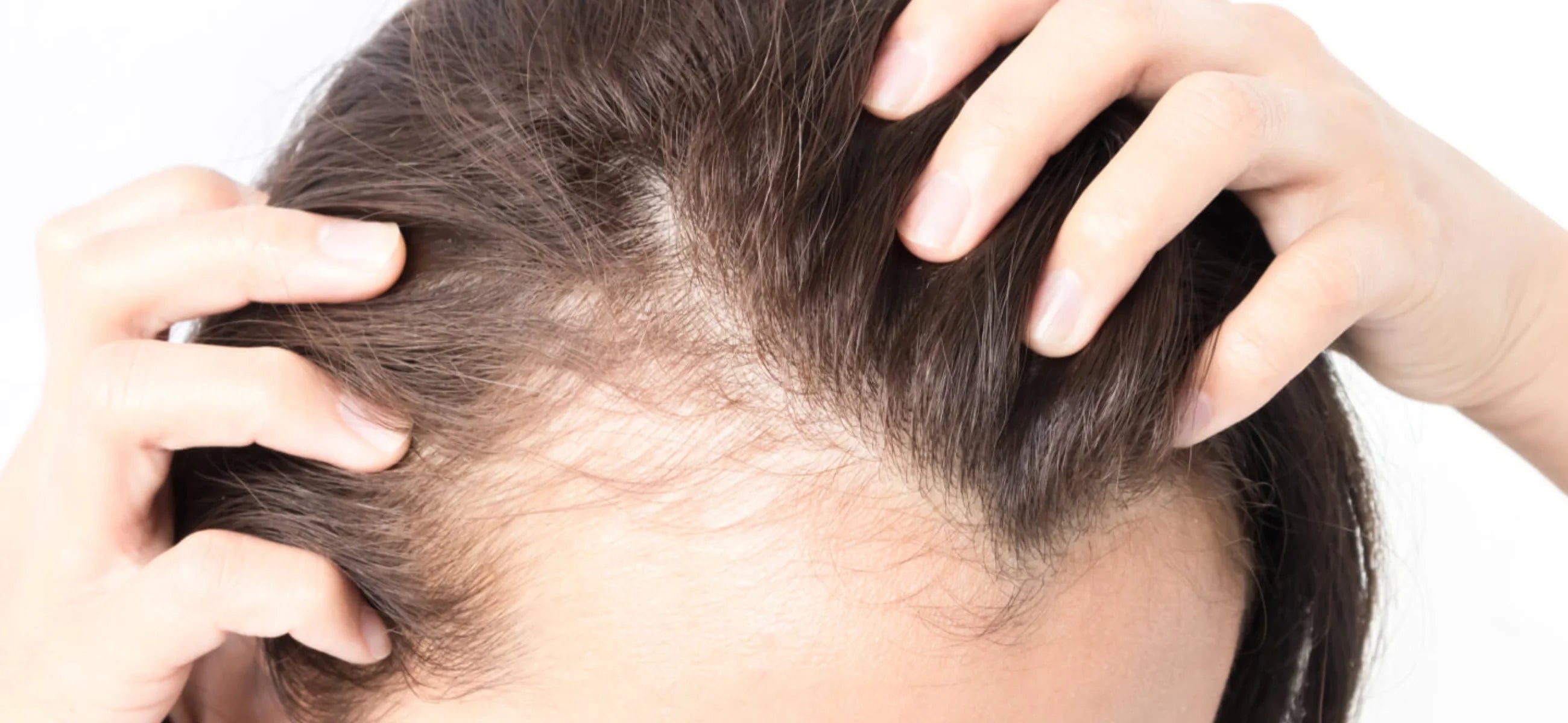 Does Ozempic cause hair loss? Understanding the facts and how to protect your hair