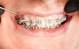 Brace yourself - how much do braces actually cost?