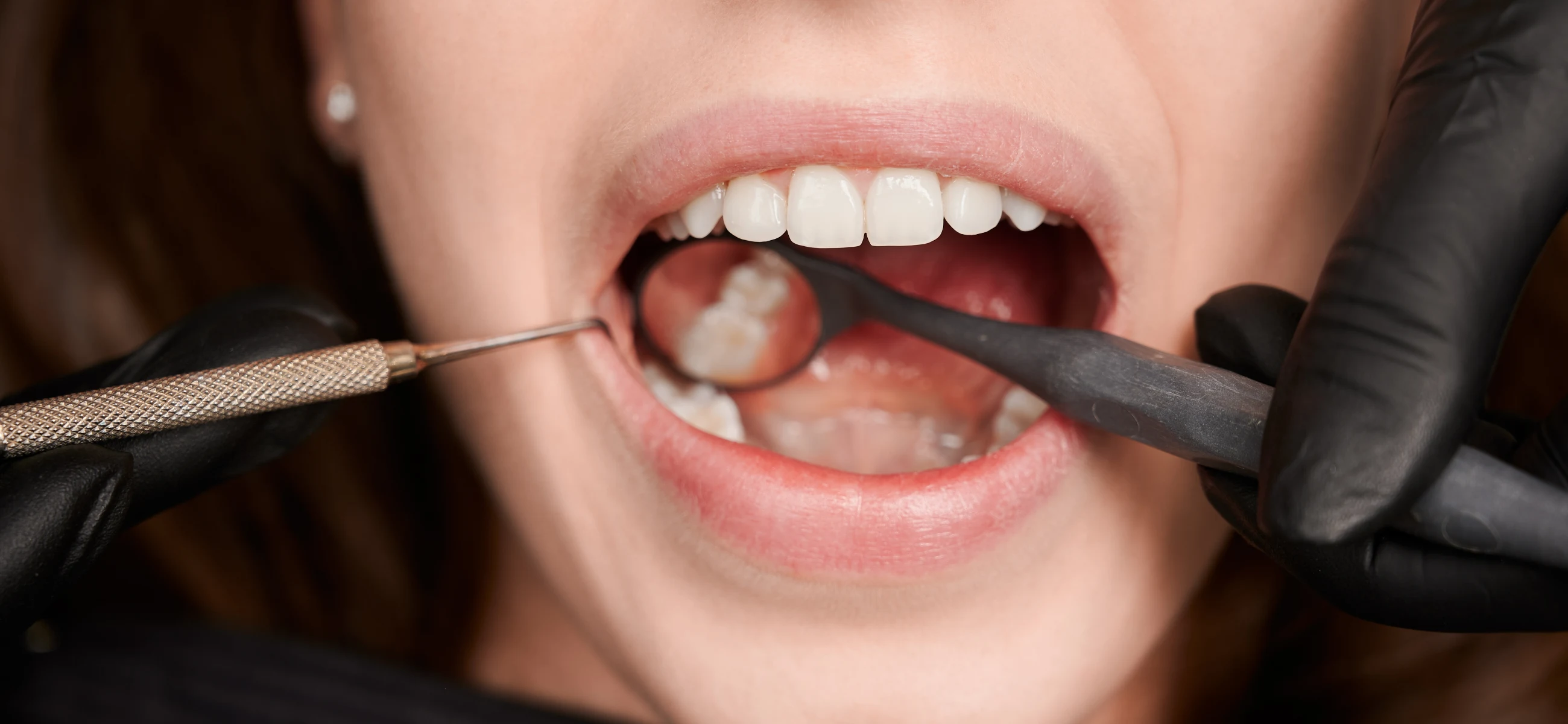 4 best cavity treatments: Is cavity treatment at home possible?