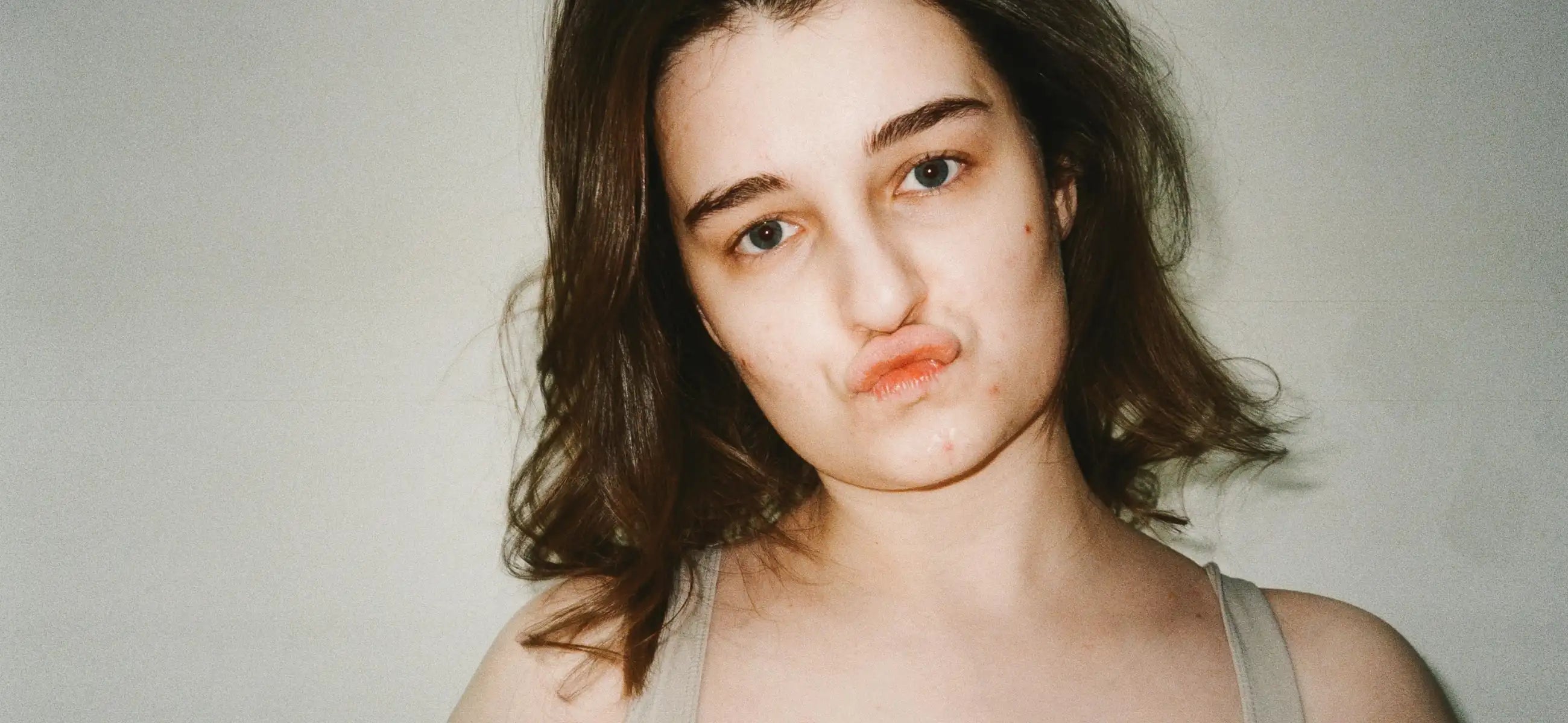 Cold sore vs. Pimple on lip: Important things you need to know
