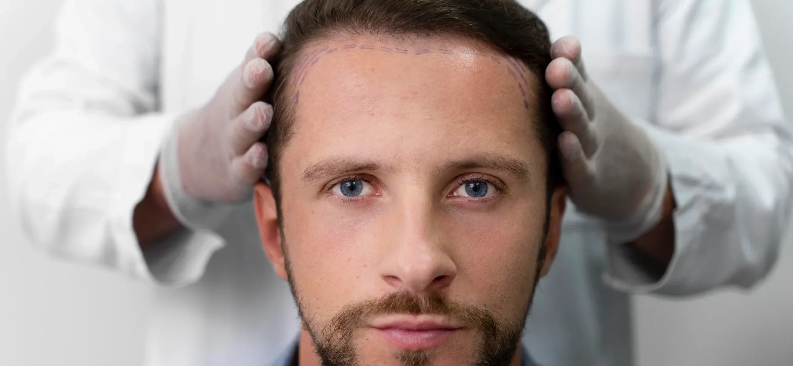 Before and after hair transplant: What’s realistic to expect