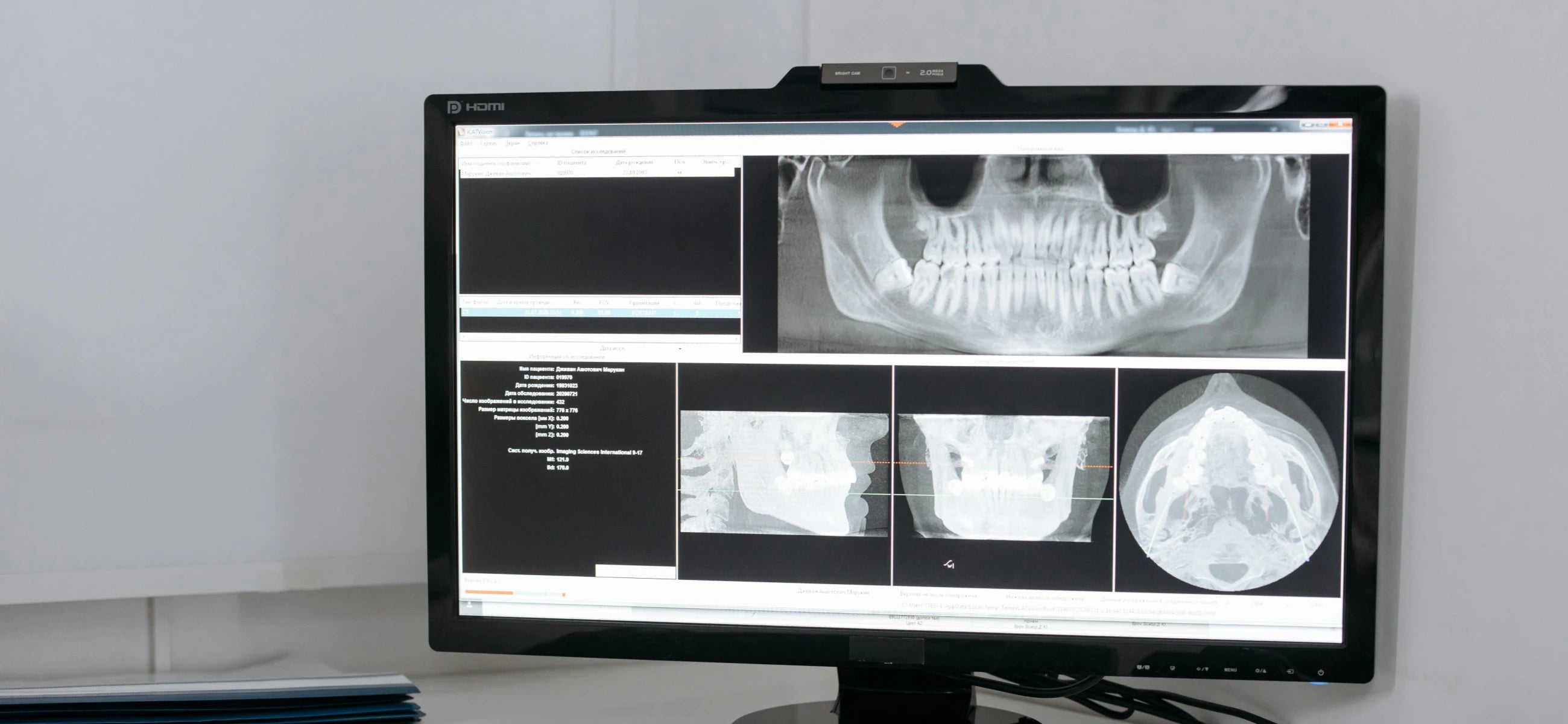 The true cost of missing teeth: How much do dental implants cost?