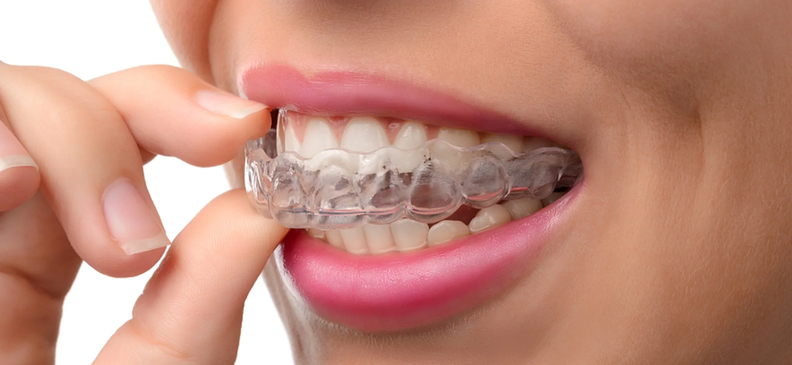 Can you straighten teeth without braces at home?