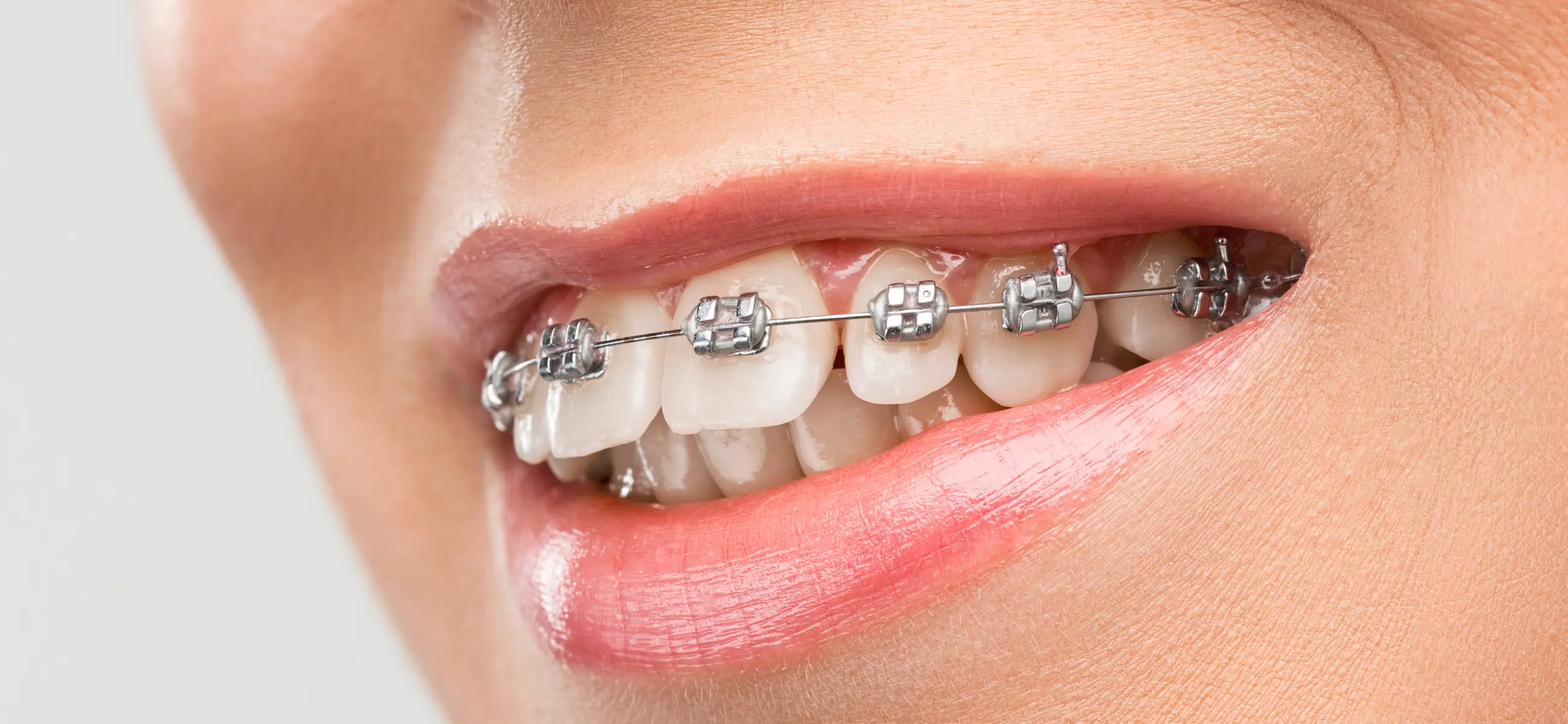 Teeth whitening methods for people with braces
