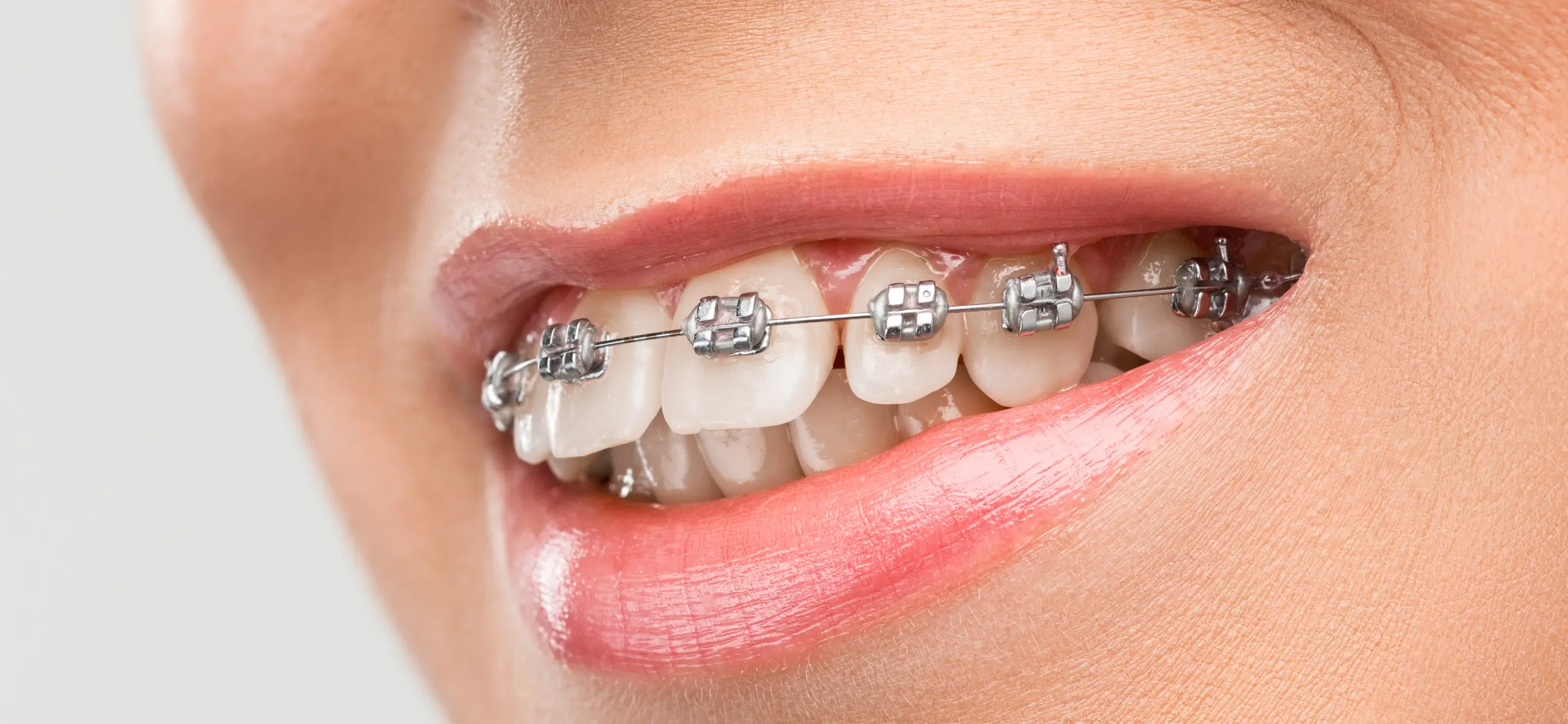 Teeth whitening methods for people with braces: 6 ways