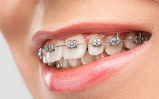 Teeth whitening methods for people with braces