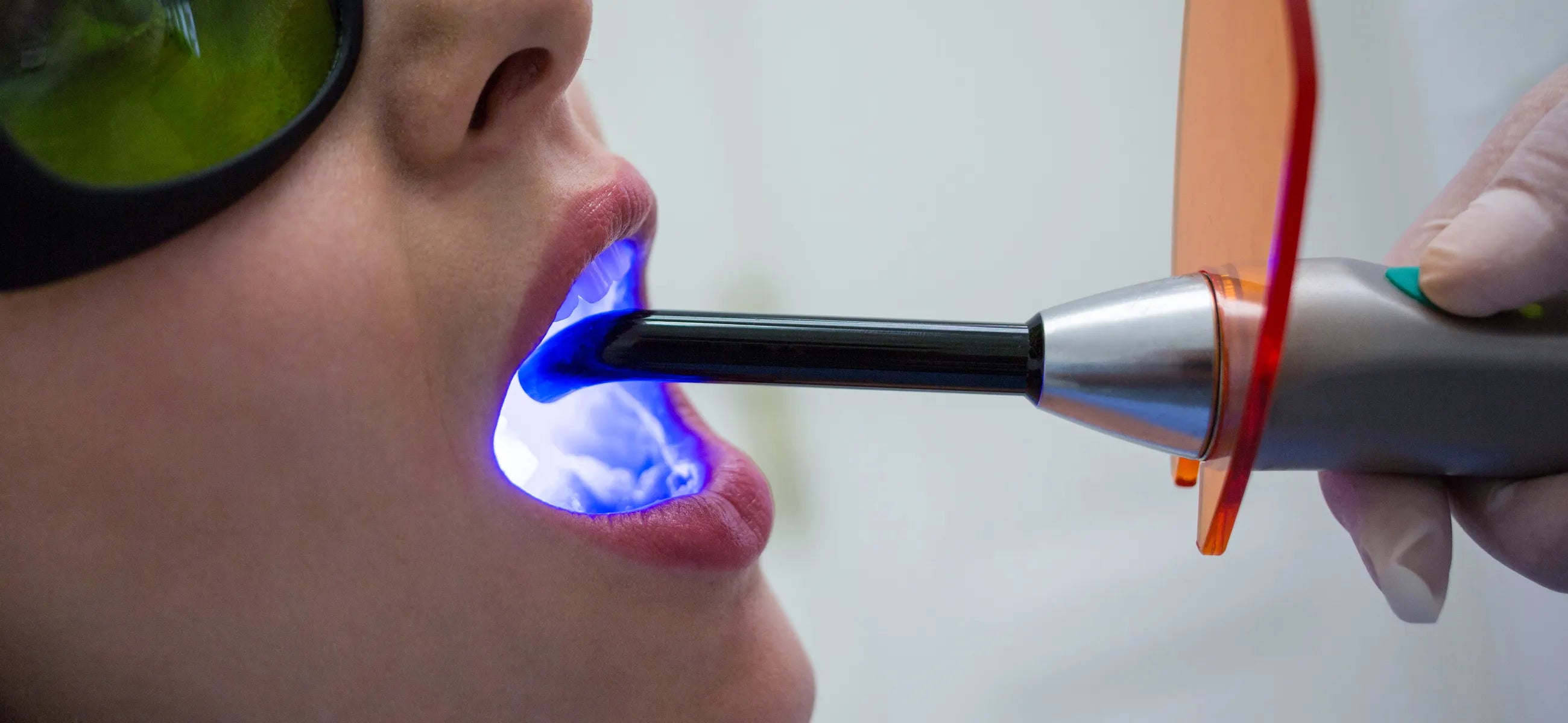 Teeth whitening 101 - what is laser teeth whitening and how does it work?