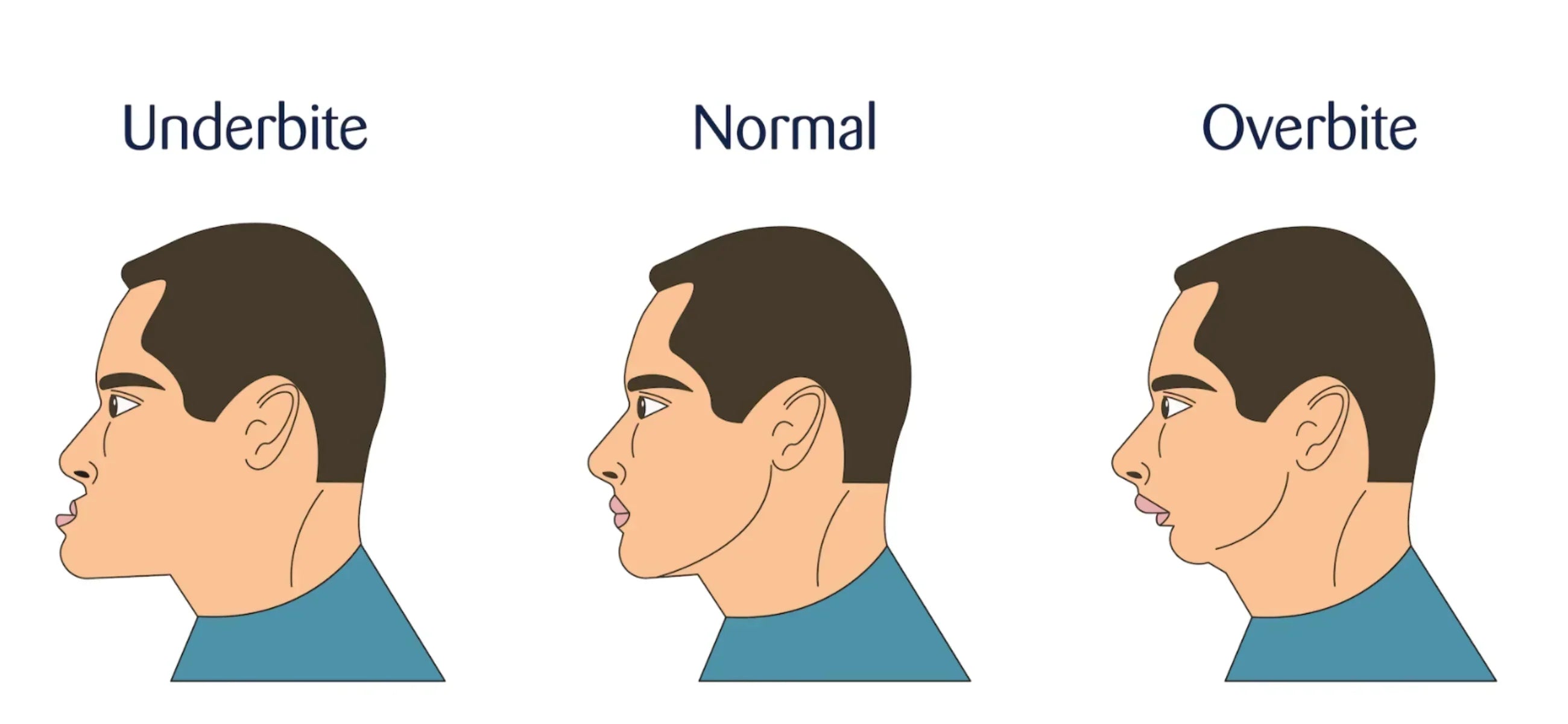 Overbite vs Underbite: What’s the difference and how are they treated?