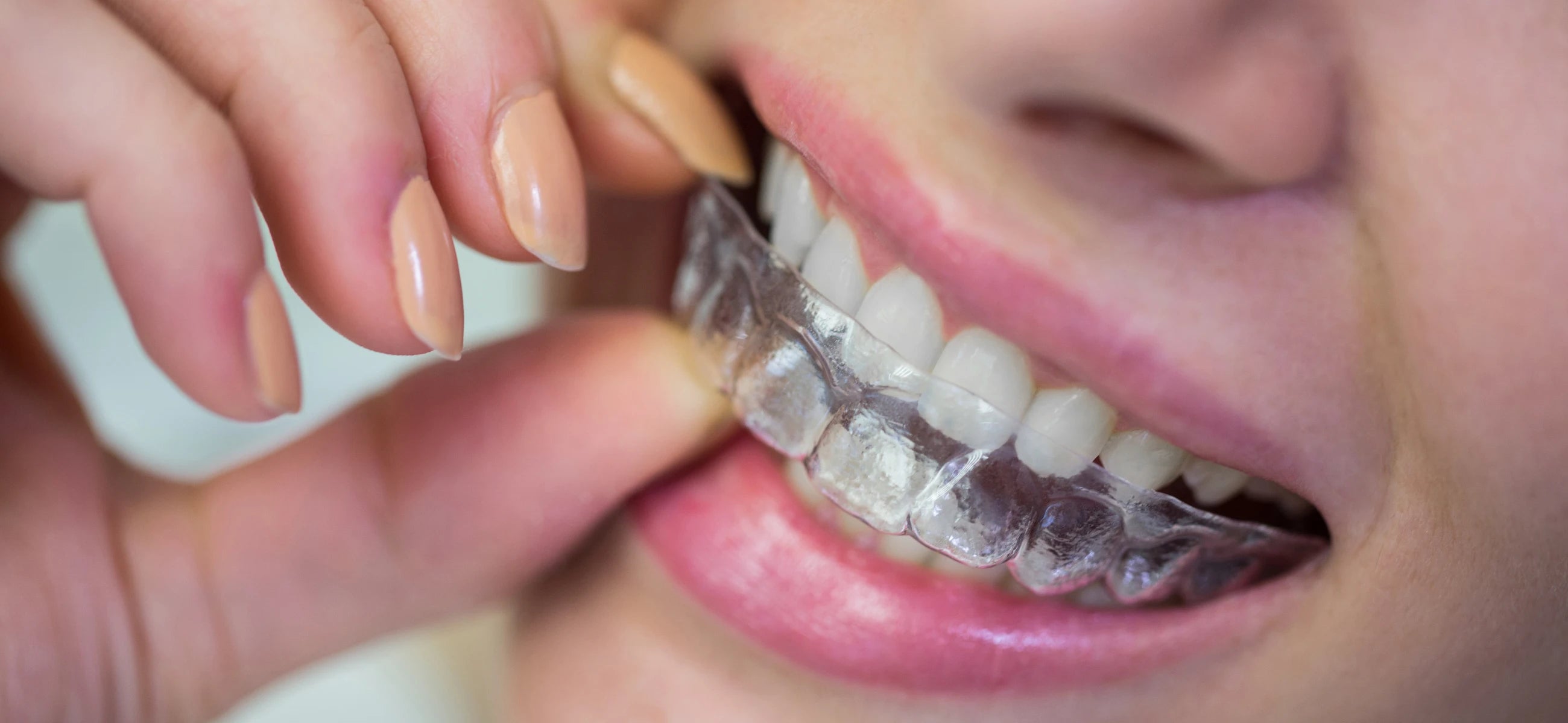 A comprehensive guide to retainer for teeth: Definition, types, and more