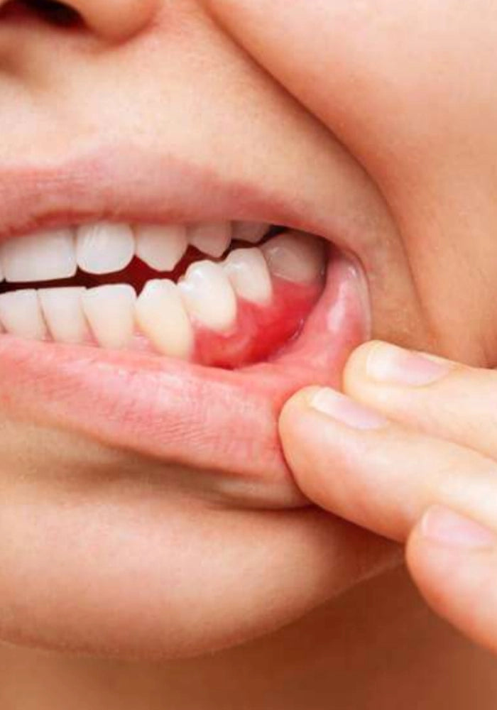 Gums feel sore